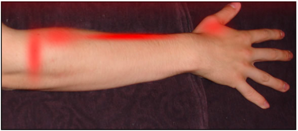 How to treat tennis elbow by massaging the brachioradialis, image 2.