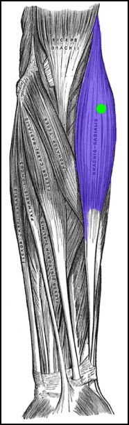 How to treat tennis elbow by massaging the brachioradialis. This image is taken from Wikipedia, and touched up to highlight the brachioradialis and its associated pain pattern.