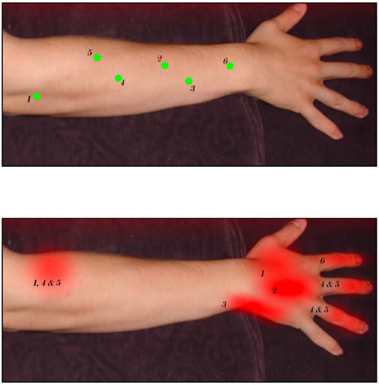 Massaging these muscle knots can help ease and cure wrist and thumb pain, even severe wrist pain, so that you can get back to lifting or playing.