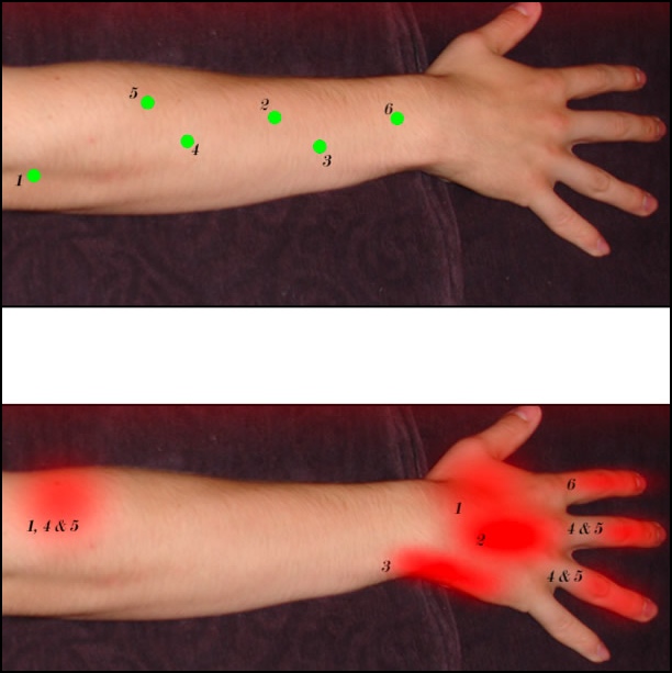 How to treat tennis elbow; extensors trigger point diagram.