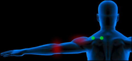 How to treat tennis elbow: Supraspinatus muscle trigger point diagram.