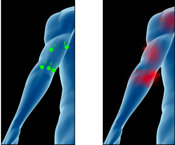 How to treat tennis elbow; tricep trigger point diagram.